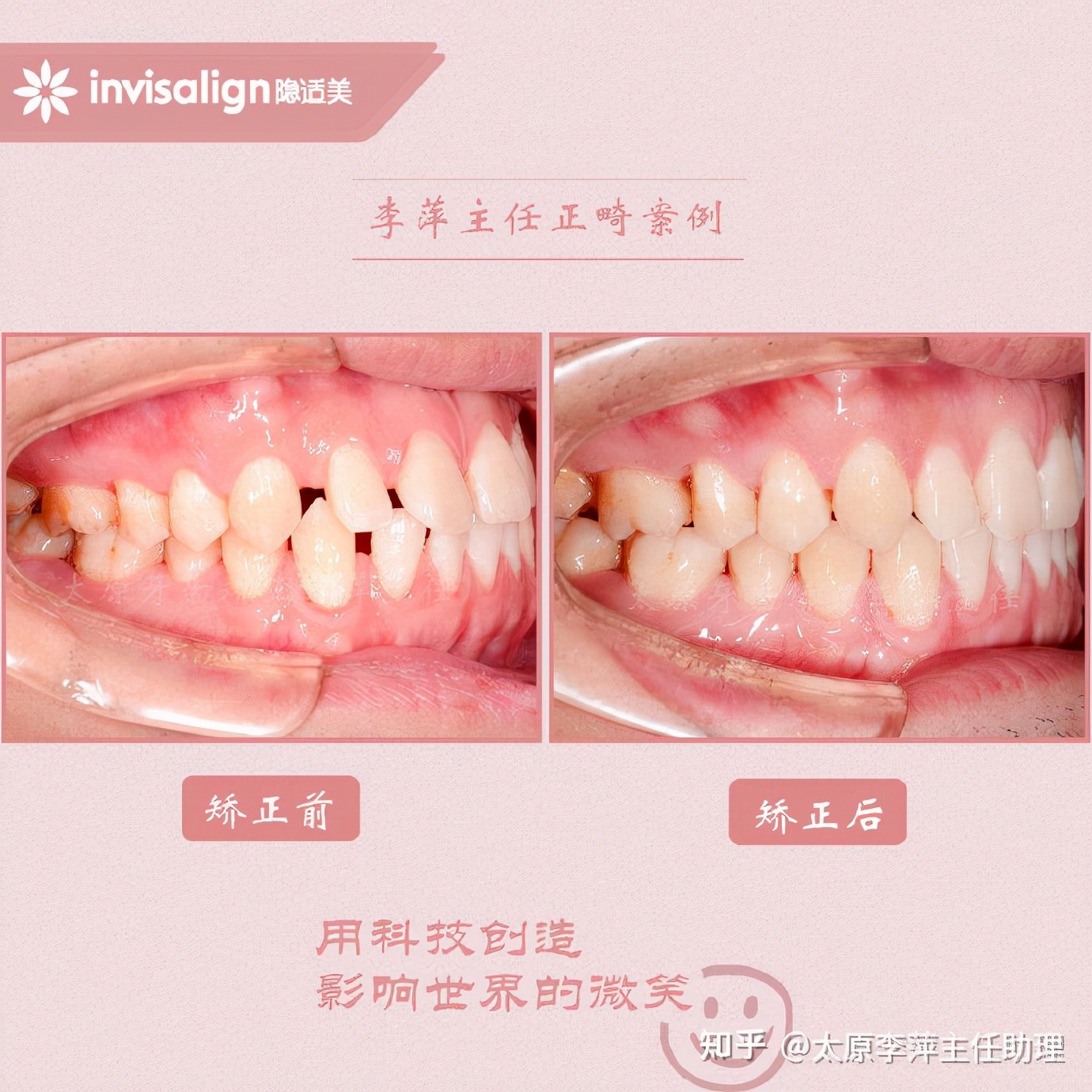 重度拥挤矫正牙齿适合隐形牙套吗,广州成人牙齿矫正推荐隐形牙套