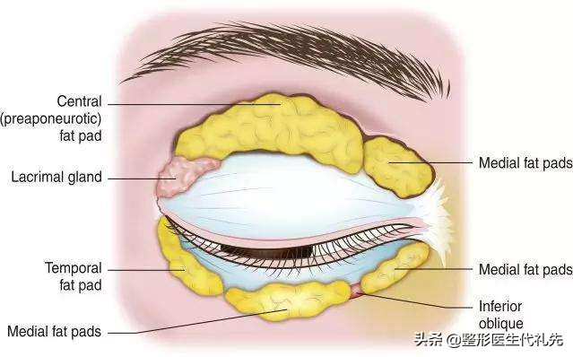 眼综合眼袋手术恢复全过程,眼周年轻化和祛眼袋