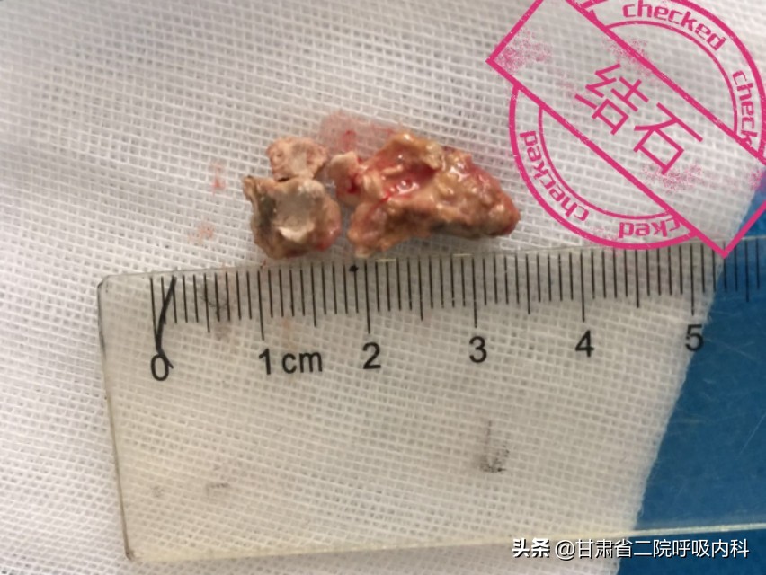 喉咙里面真的有石头吗,喉咙里会长石头吗