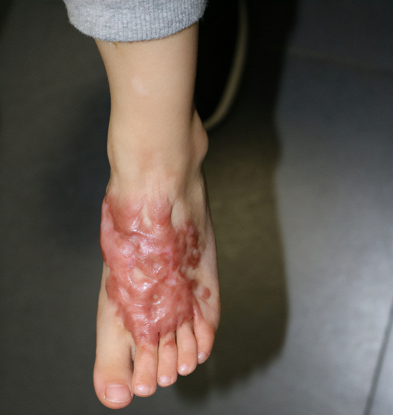 怎么治疗烧伤疤痕增生,烧伤疤痕的增生期是多久