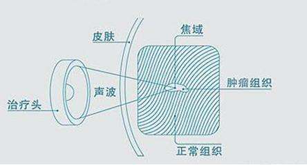 聚焦超声手术治疗能根治子宫腺肌病吗？