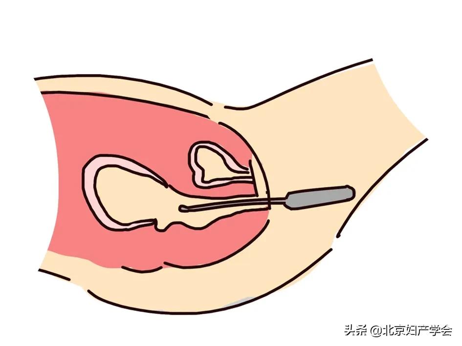 子宫内膜息肉的诊断和护理,7*3mm的子宫内膜息肉