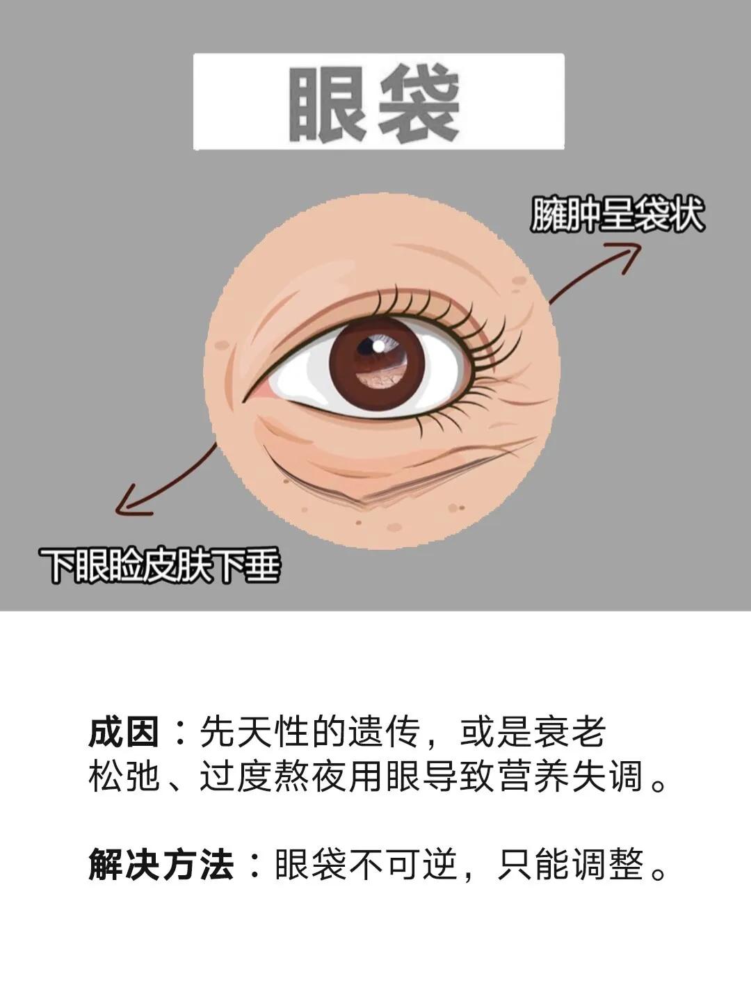黑眼圈脂肪粒和细纹,一招解决眼袋黑眼圈眼角纹