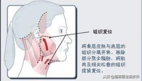 脸松弛下垂法令纹做什么医美手术,法令纹苹果肌下垂做什么手术