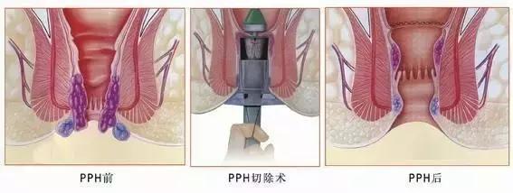 痔疮到底能疼多少天,痔疮到底能不能变小