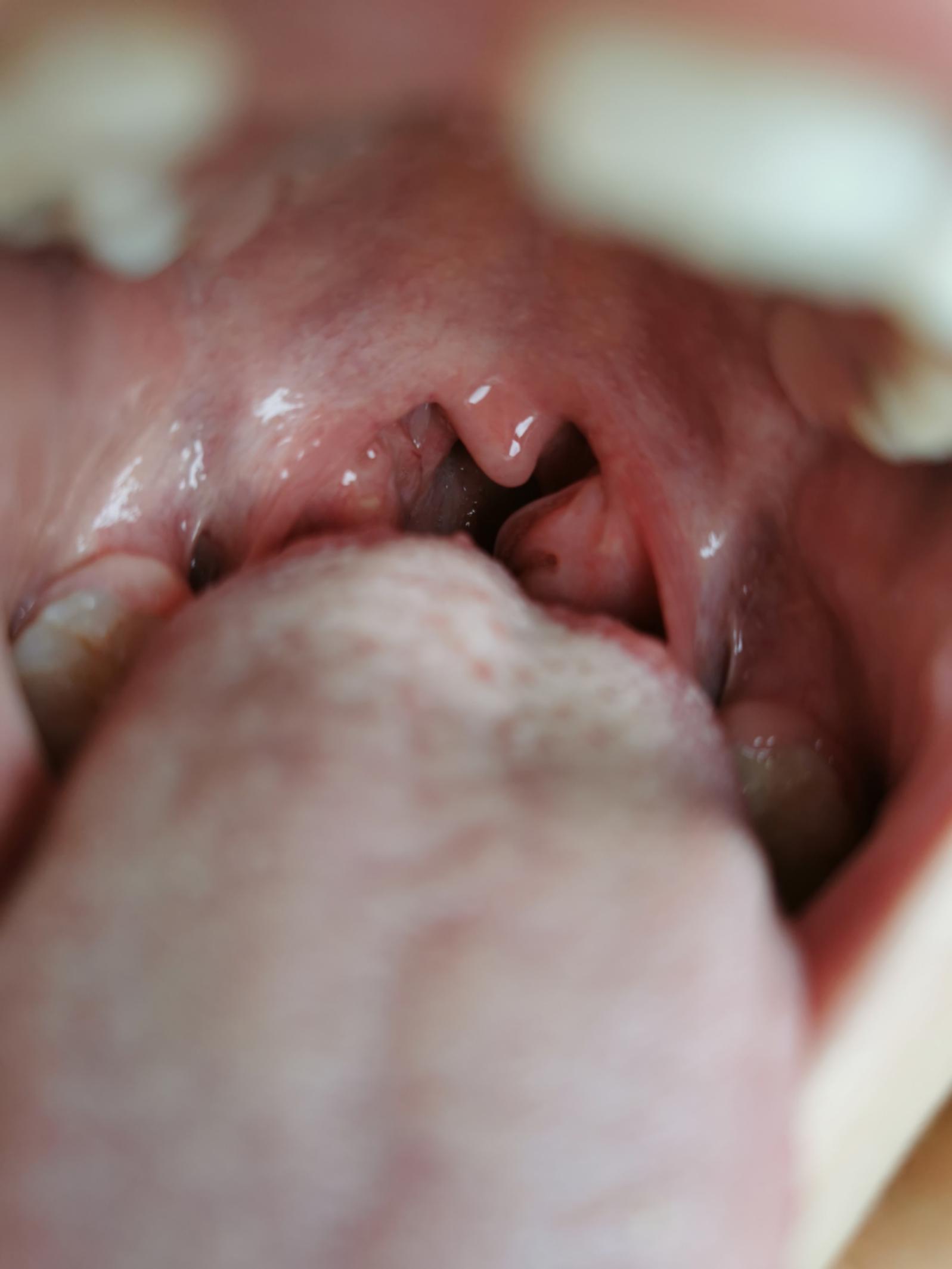 喘息咳嗽一直不好怎么办,喘息一直不好雾化也不行