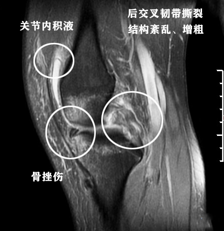 膝关节核磁共振报告单上怎么看,膝关节核磁正常报告单