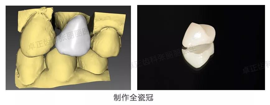 牙齿楔状缺损修复视频,牙齿缺损了可以选择哪些修复方式