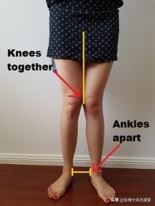 体态矫正小腿外翻,成年人x型腿加膝外翻怎么办