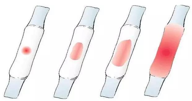 月经过多的原因是什么呢,月经过多针灸穴位