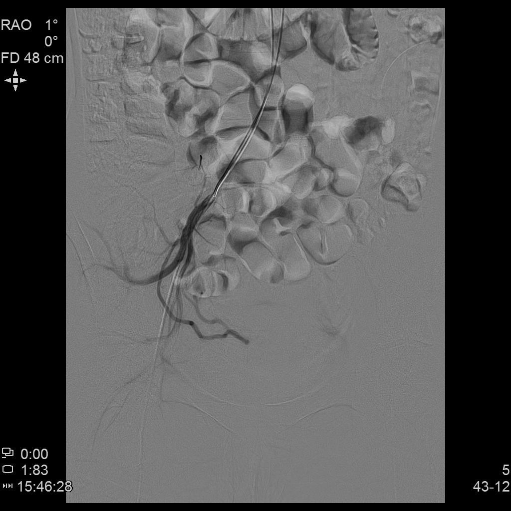 「不死的癌症」之克星——子宫腺肌症介入栓塞治疗