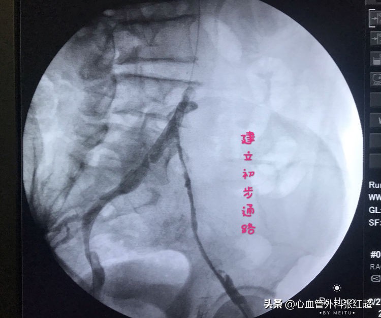 外周血管治疗图,外周血管疾病怎么治