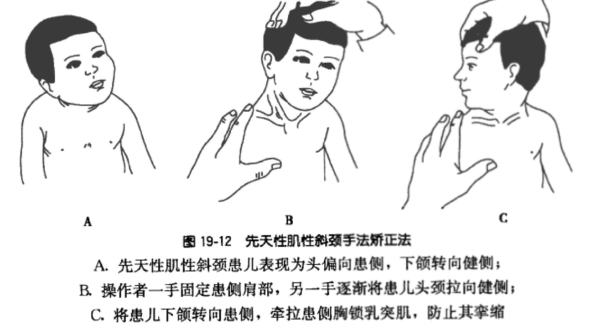 胸锁乳突肌病变痉挛时可引起斜颈,胸锁乳突肌和痉挛性斜颈有关系吗
