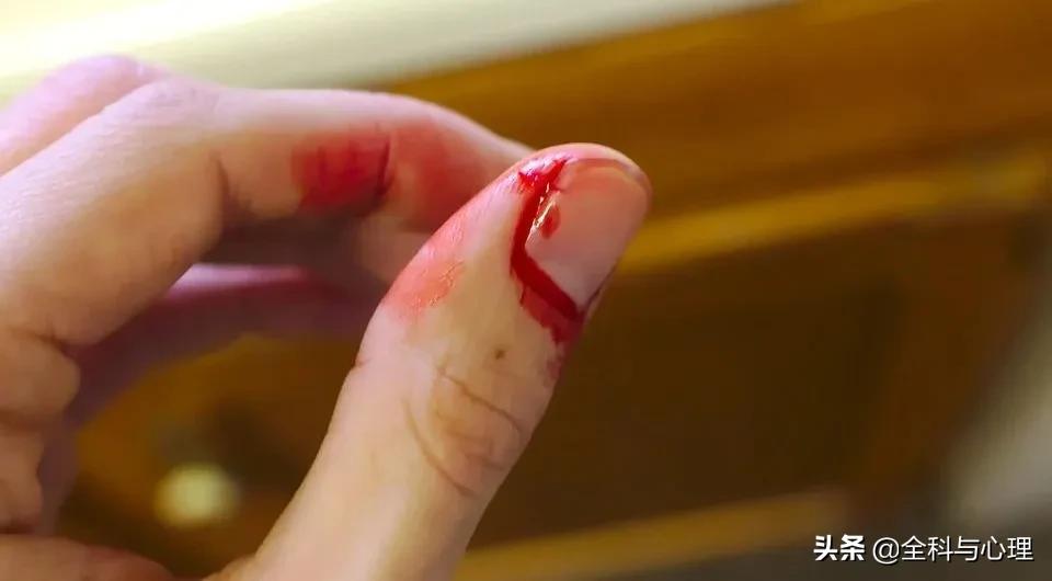 铁丝扎破手指出血会得破伤风吗,绣花针扎破手指需要打破伤风吗