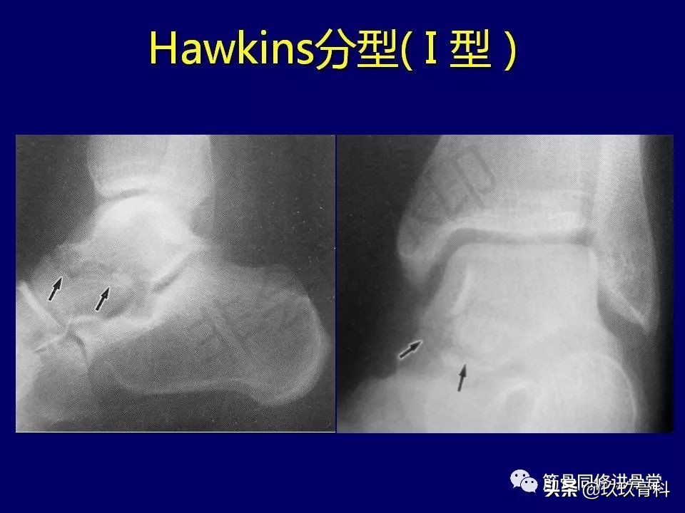 距骨骨折后遗症,距骨骨折怎么办