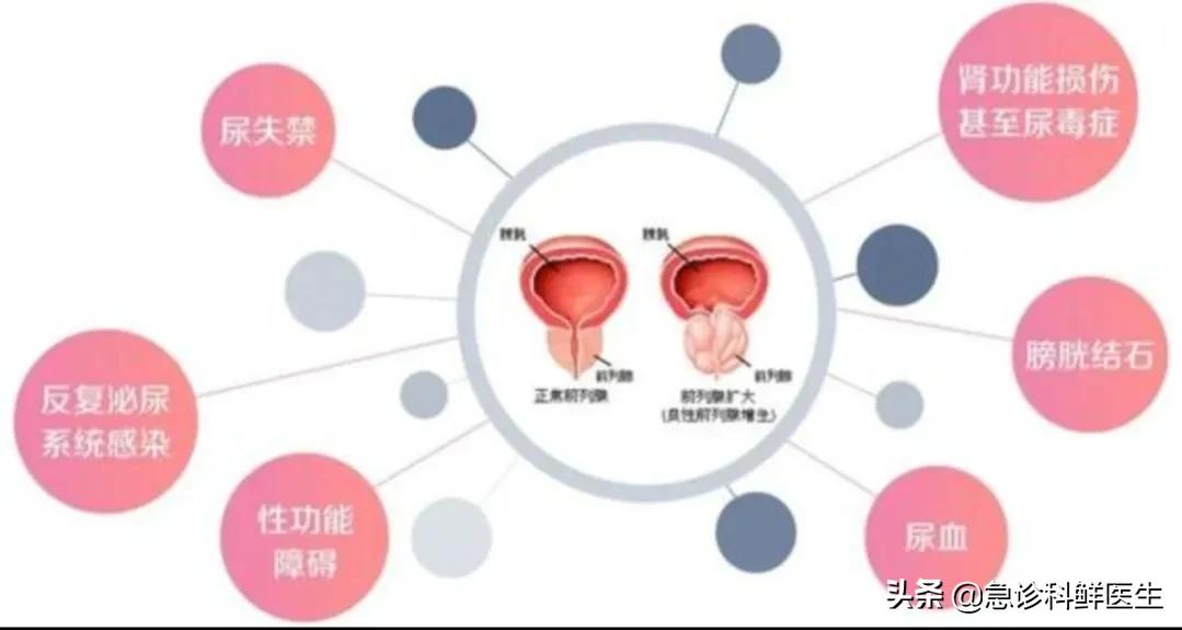 得了前列腺增生怎么治疗会好,前列腺增生怎么治疗最快最有效