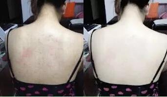 羊奶皂能去鸡皮肤吗,驴奶皂与羊奶皂哪个好