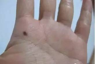 色素痣有可能恶变吗,哪些色素痣可能变为皮肤癌