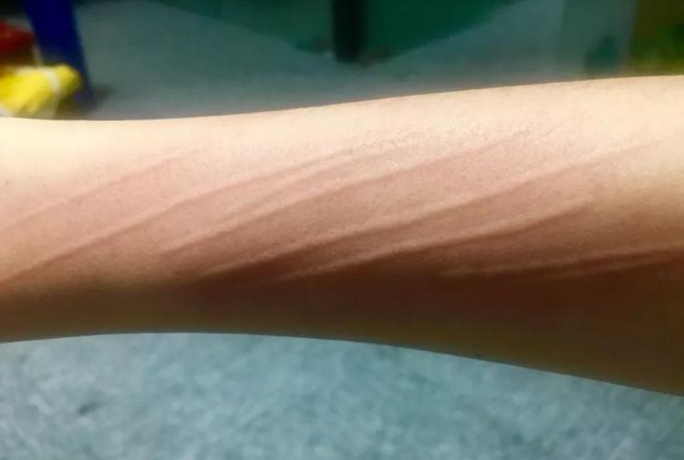 儿童被鸡抓伤长出鸡脚,小孩被鸡抓伤会留疤吗