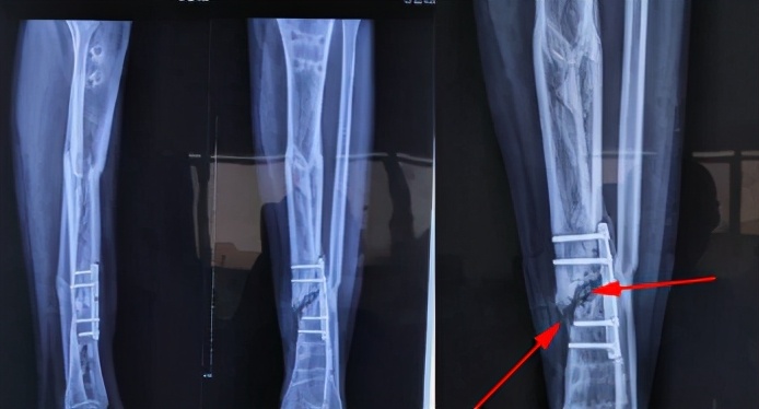 骨折术后为什么总是不舒服,骨折术后为什么有的人不愈合