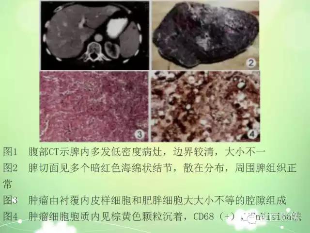 脾血管瘤中医辨证,脾血管瘤超声表现