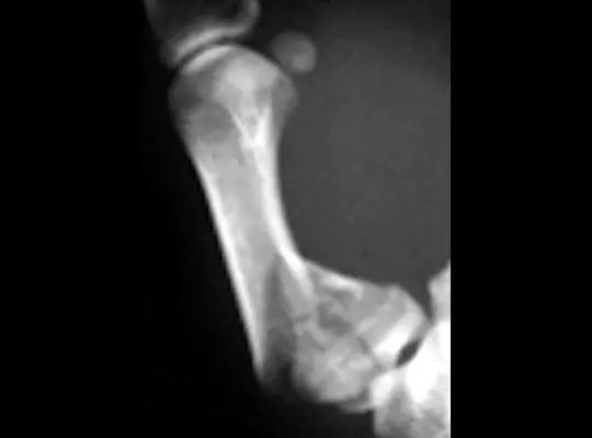 特殊骨折类型,特殊骨折体征