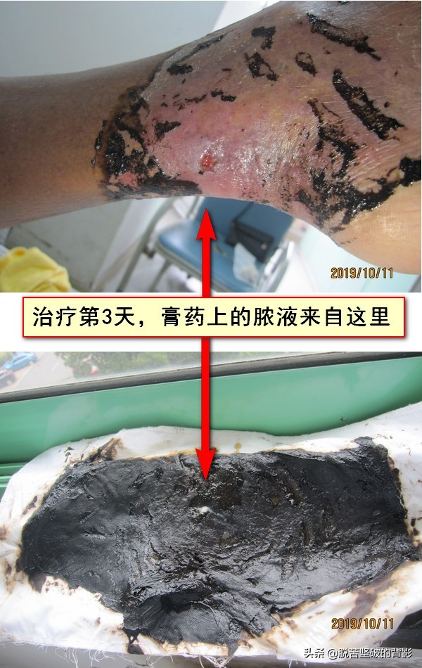 小小外伤4年8次住院，三甲医生举案说法：健康无小伤，手术须慎行