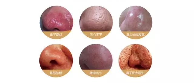 这令人烦心的酒糟鼻到底该如何应对？