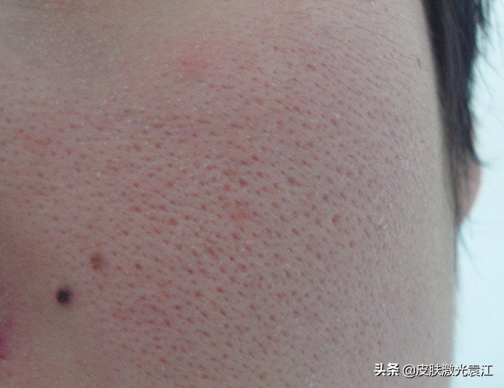 毛孔粗大5种类型改善方法,毛孔粗大程度分级