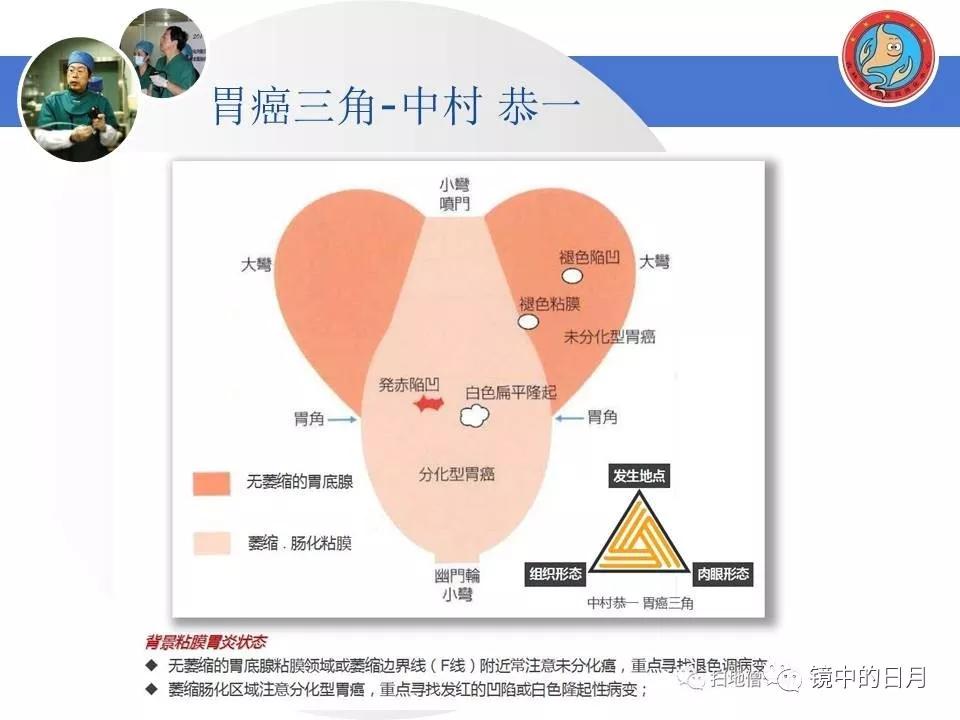 低分化胃癌早期时候做内镜手术吗,早期胃癌内镜手术后追加外科手术