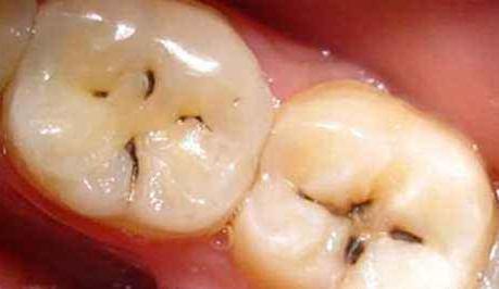 牙齿有黑线就证明里面坏了吗,牙齿有黑渍一定是龋齿吗