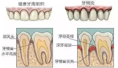 牙缝越来越大是什么导致的,牙缝越来越大什么病中医怎么说