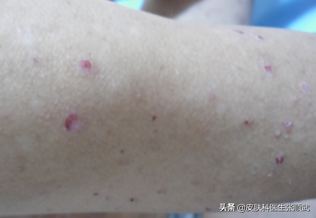 银屑病怎么治疗才好得快,看中医调理银屑病