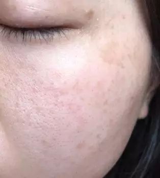 敏感肌可以做激光祛斑吗,激光祛斑问诊