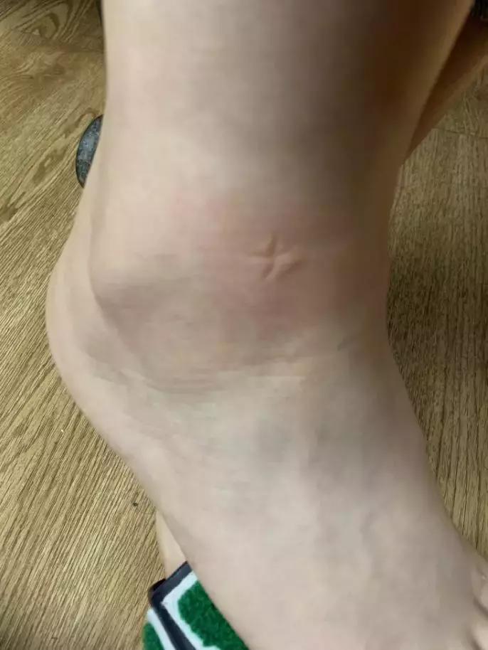 孕妇被蚊子咬了怎么止痒消肿,蚊子咬了止痒消肿最快的办法