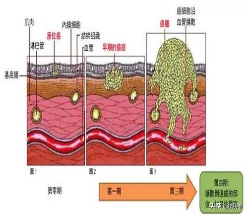 胃低级别上皮内瘤变可以不治疗吗,胃低级别上皮内瘤变怎么处理
