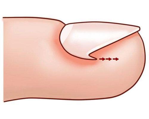 脚趾嵌甲怎么修剪,脚趾嵌甲严重长肉芽自己如何处理