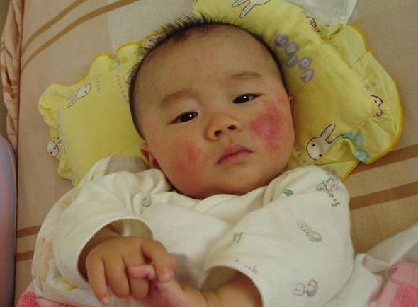 新生儿身上长红疹不可轻视，民间偏方使用需谨慎！