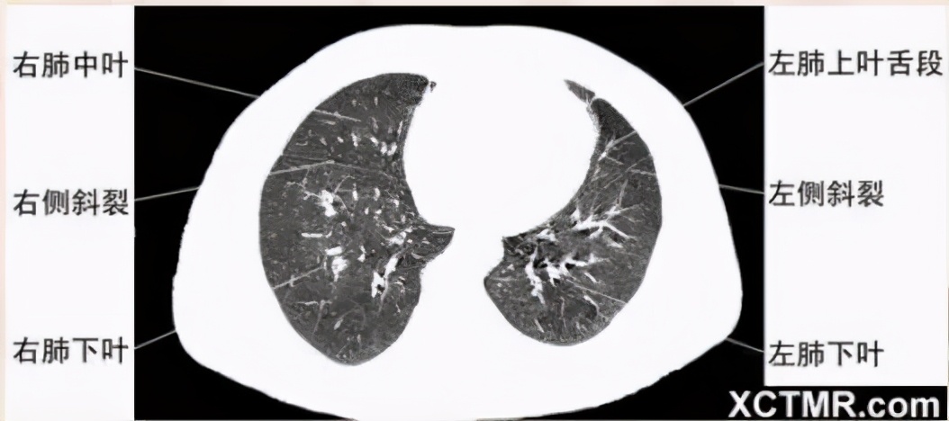 女性盆腔ct断层解剖结构图,女性盆腔脏器ct解剖