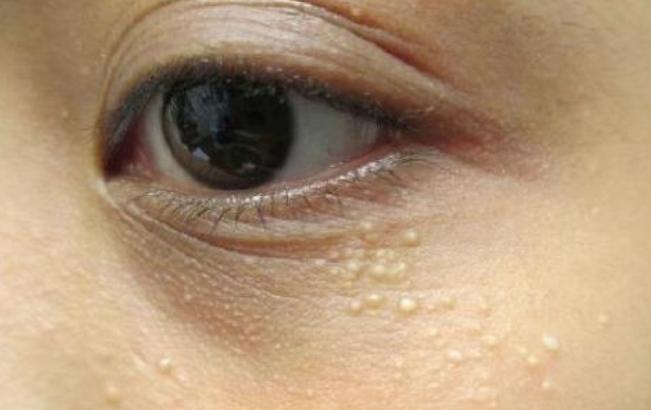 眼睛下边长的脂肪粒用什么能去掉,眼睛下面长脂肪粒去除小妙招
