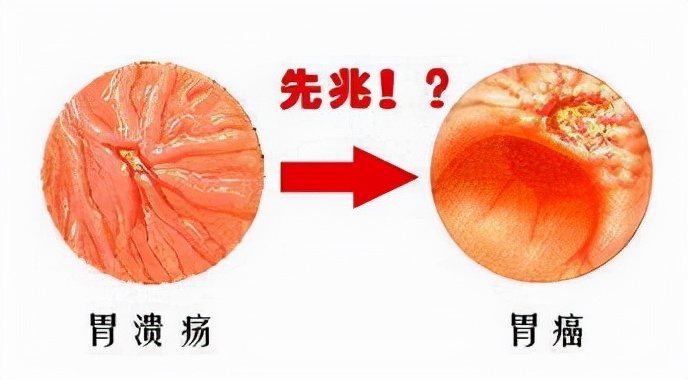 胃溃疡严重后果是什么,胃溃疡导致的后果