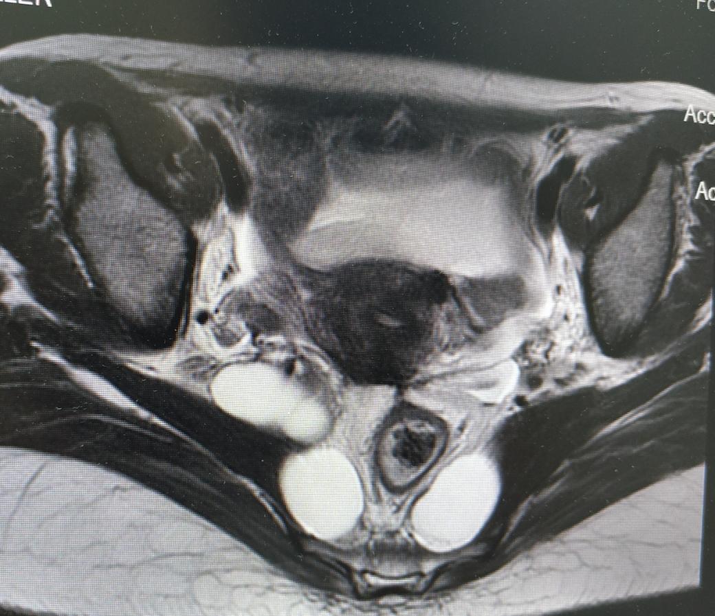盆腔包块怎么得的,病例分享案例
