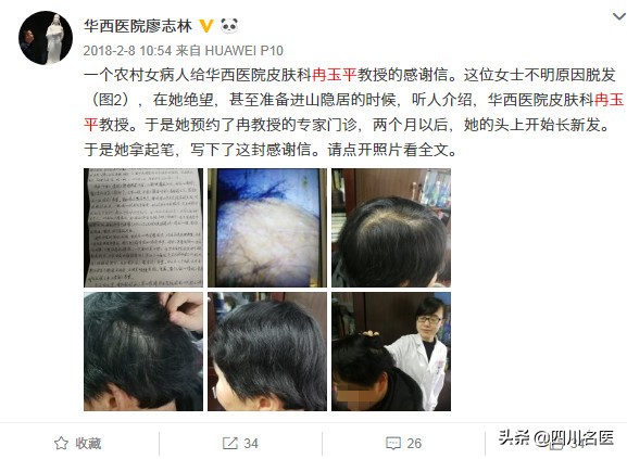冉玉平医生治脱发怎么样,四川大学华西医院斑秃专家冉玉平