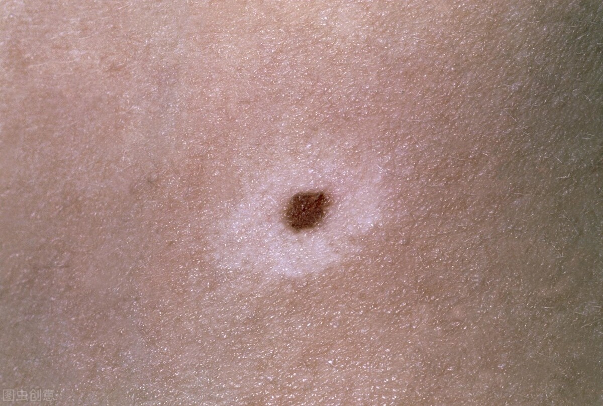 老年人高发的4种皮肤病，要注意防范