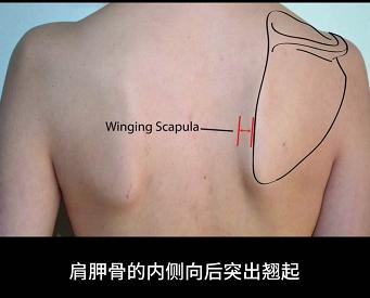 改善蝴蝶背的方法,天生的蝴蝶背能改善吗