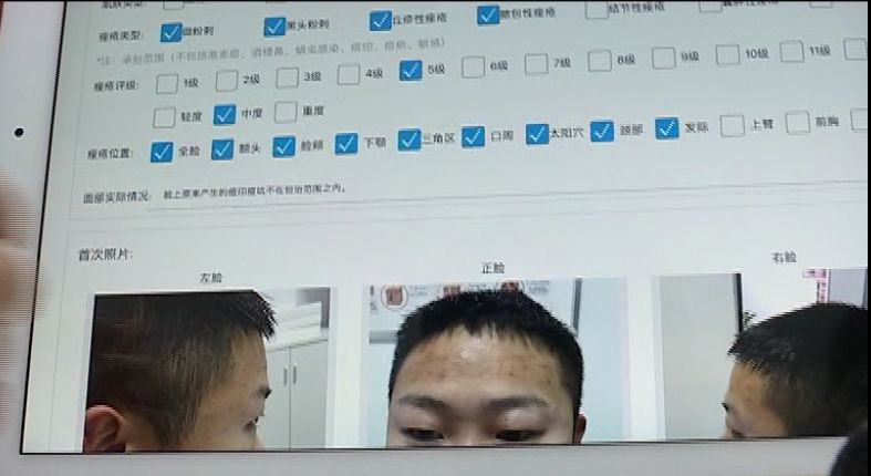 16元祛痘体验贵阳,15元体验祛痘贵阳