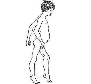 孕妇怎样检测进行性肌营养不良,进行性肌营养不良症孕期能查出吗