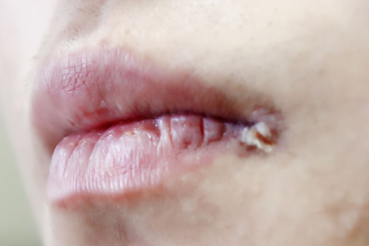 嘴角起小水泡是不是上火了,5岁的女儿3岁的儿子嘴角长水泡