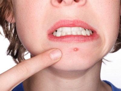 下巴长痘痘是什么原因引起的50岁,30岁下巴长痘痘是什么原因引起的