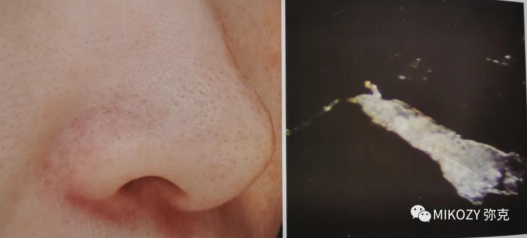 去除陈年深黑头,清理黑头哪家强